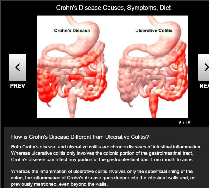ulcerative and chrons.JPG
