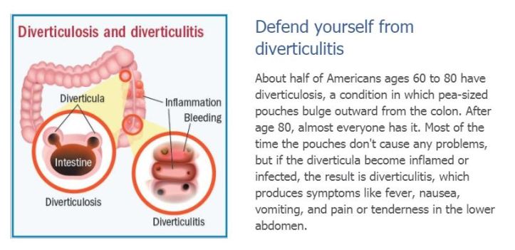 diverculitis 00