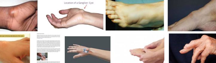 ganglion cyst